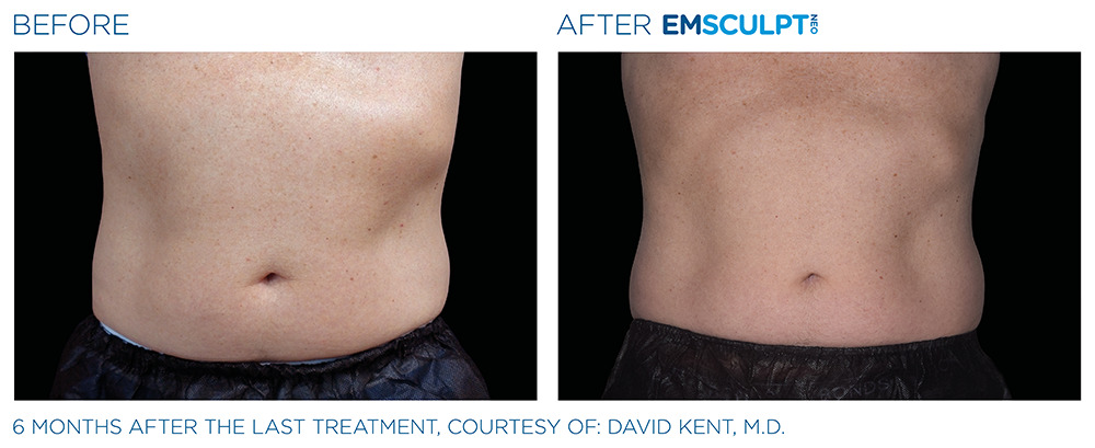 Differences between CoolSculpting and Emsculpt – What is Best for Me? -  Sculpt MD