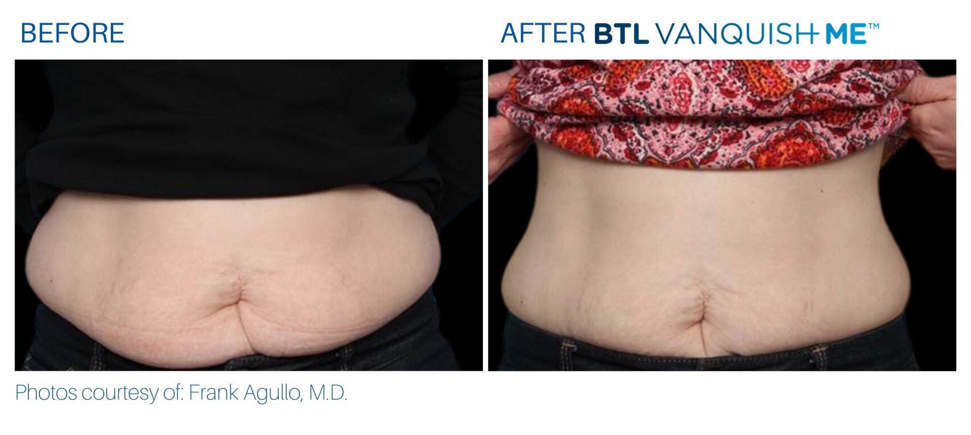 BTL_Vanquish_ME_before_and_after_abdomen_female_2