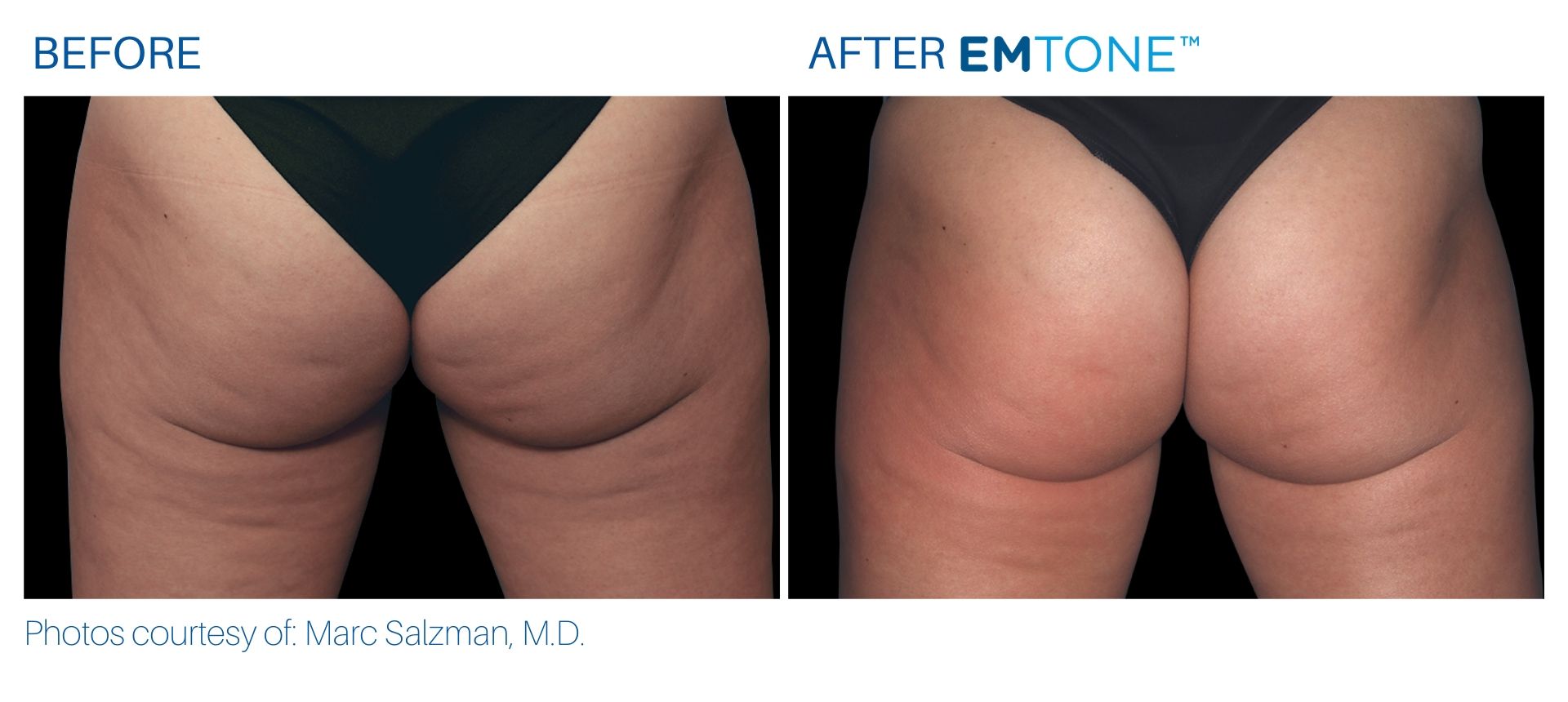emtone_before_and_after_bodymorphmd_1