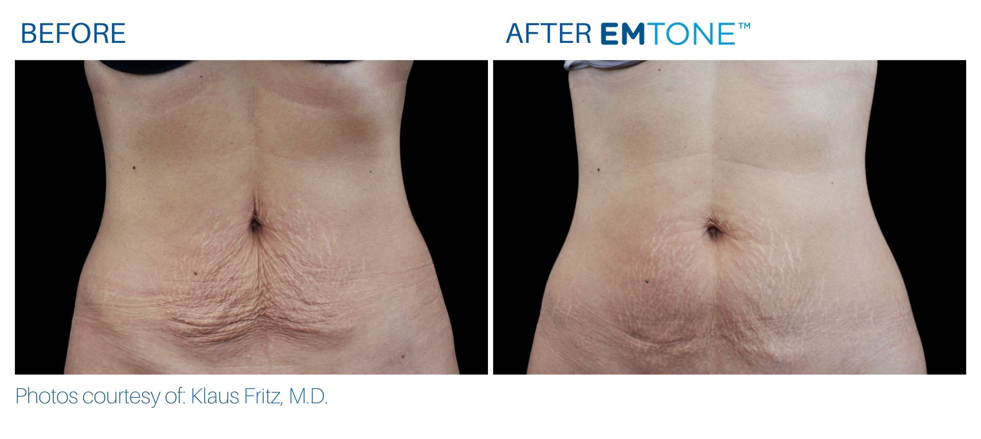 emtone_before_and_after_bodymorphmd_2