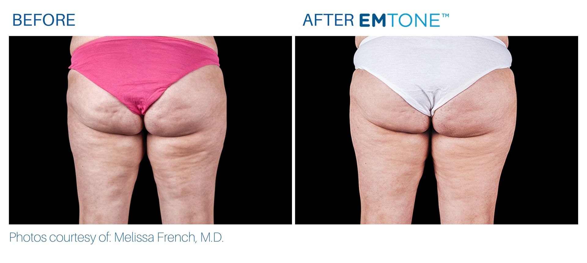 emtone_before_and_after_bodymorphmd_3