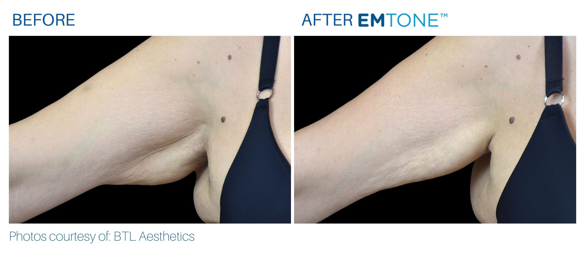 emtone_before_and_after_bodymorphmd_4