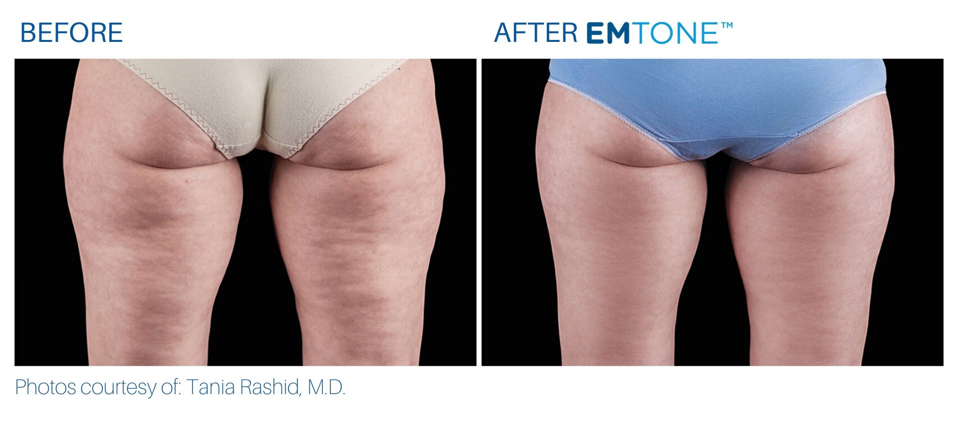 emtone_before_and_after_bodymorphmd_5