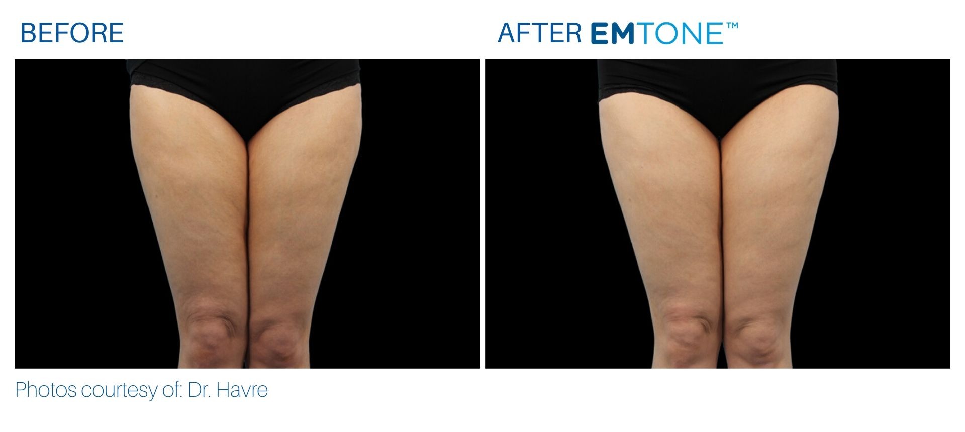 emtone_before_and_after_bodymorphmd_6