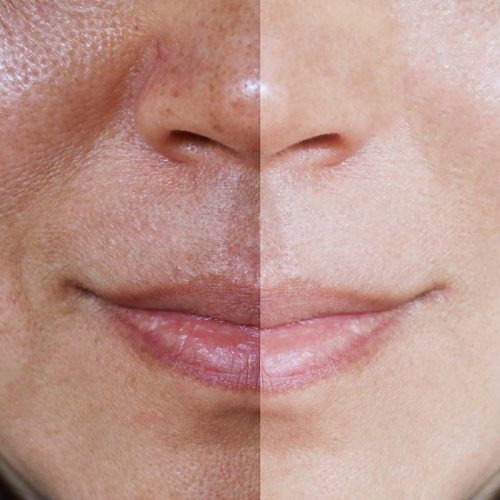 Face with open pores and melasma before and after make up or treatment concept.